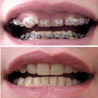 Orthodontic Treatment