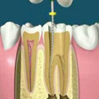 Tooth Whitening and Bleaching